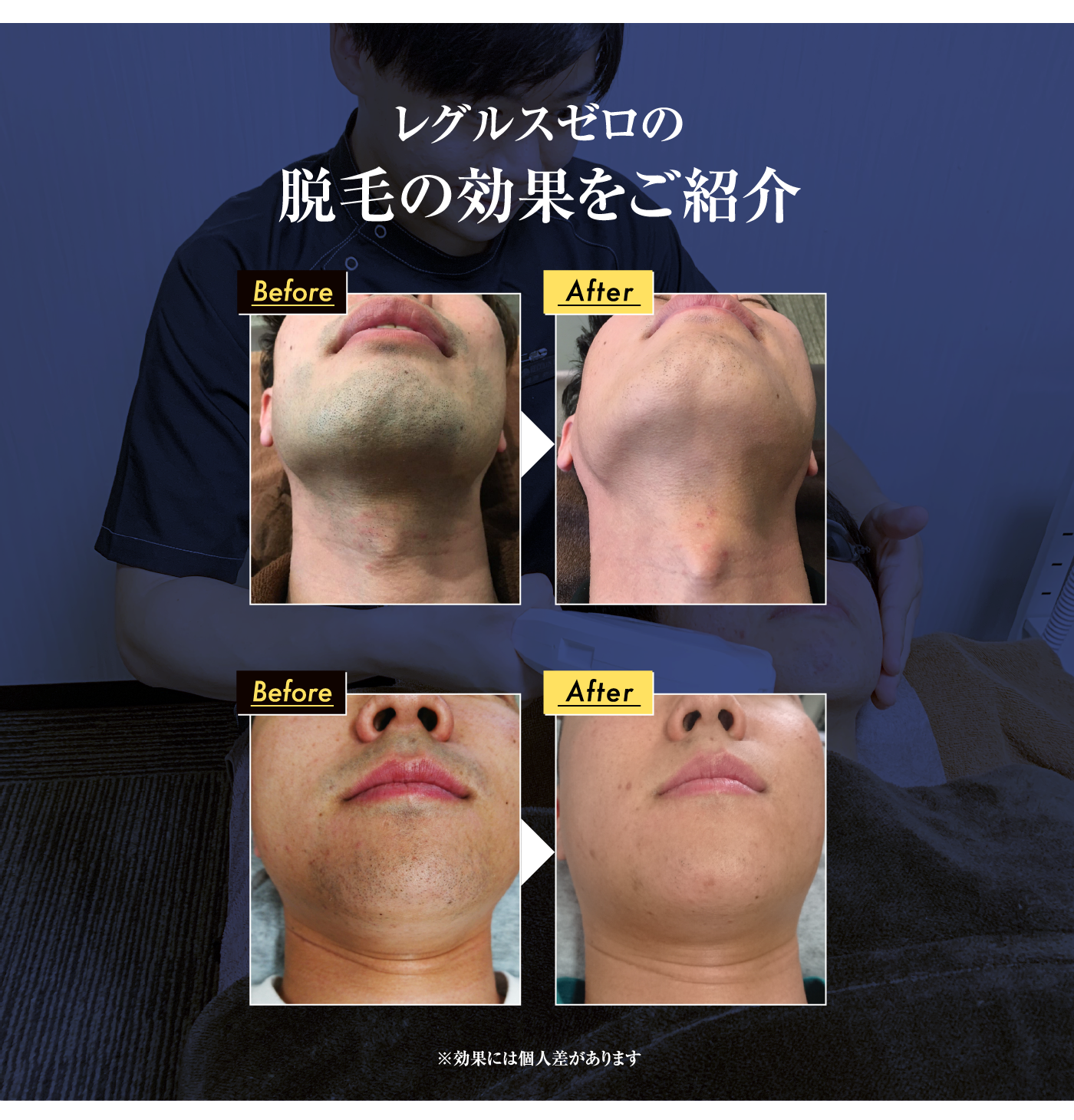 レグルスゼロの脱毛の効果をご紹介